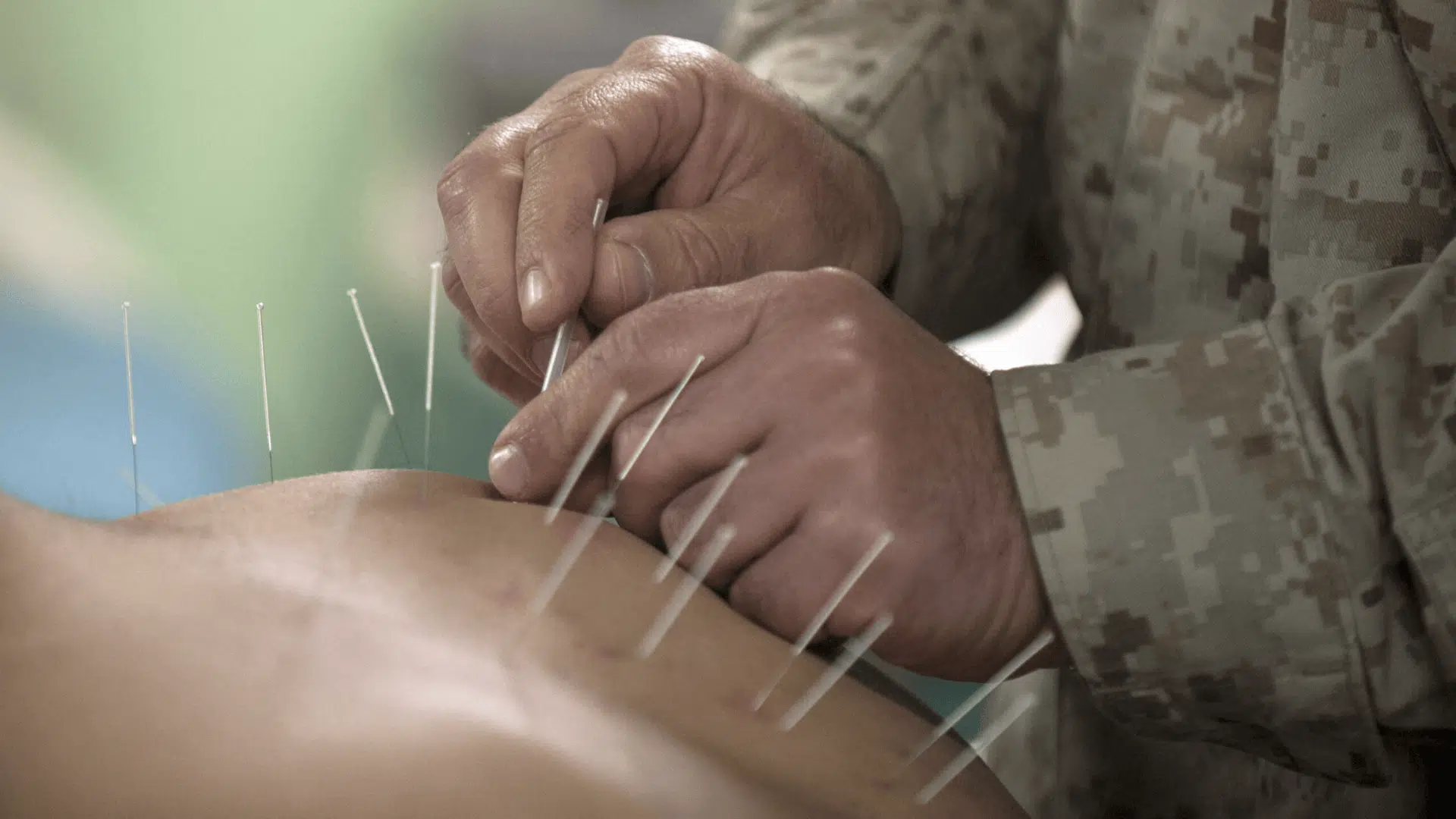 acupuncture-benefits-top