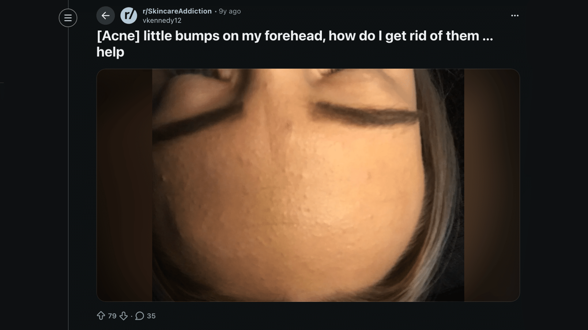 how to get rid of forehead bumps